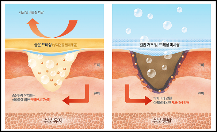 메디폼-한국먼디파마 유한회사-이미지