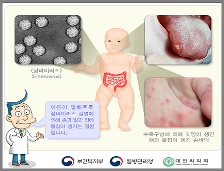 수족구 증상 사진-질병관리청