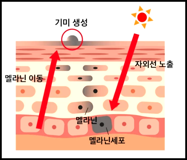 기미-원인-자외선-노출-그림