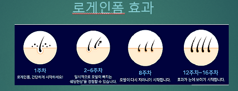 탈모치료제 - 로게인폼 가격과 직구 및 후기. 여성에게도 효과가 있는가? 2