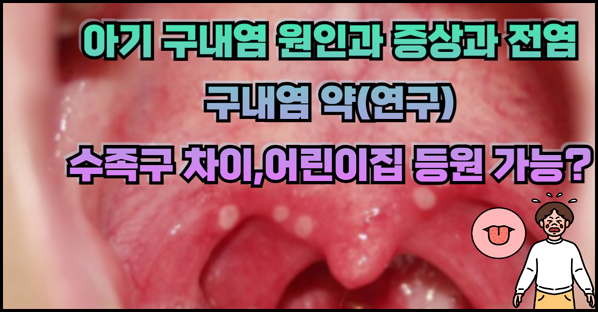 아기 구내염 원인과 증상과 전염, 약-수족구 차이,어린이집 등원 가능?