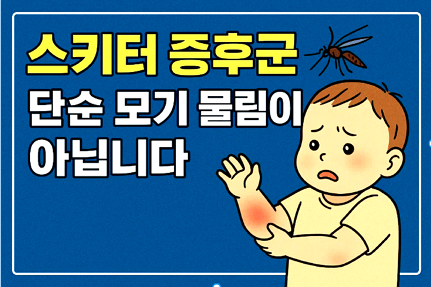 아이유 스키터 증후군
