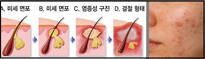 실리실산-여드름 형태와 피부사진